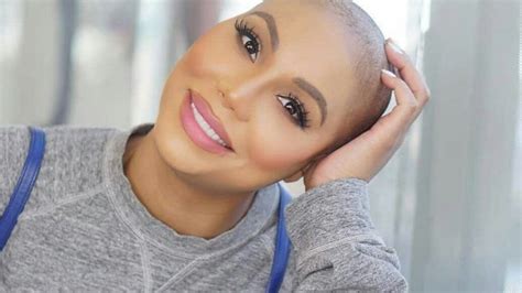 Tamar Braxton Explains Away Skin Bleaching Rumors With Vitiligo