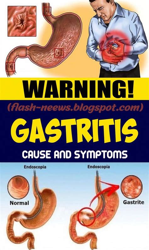 Irritation Of The Mucous Film Of The Stomach Is Called Gastritis It