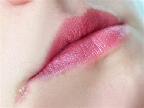 How To Heal The Corners Of Your Lips
