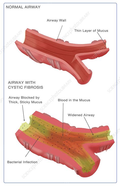 Cystic Fibrosis Illustration Stock Image C0276707 Science Photo