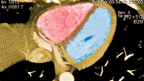 Verdict High Diagnostic Accuracy For Coronary Ct In Nsteacs