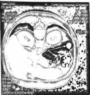 Полип сигмовидной кишки диета Клинические проявления, Диагностика (принципы и этапы постановки Клинические проявления, Диагностика (принципы и этапы постановки Полип сигмовидной кишки диета