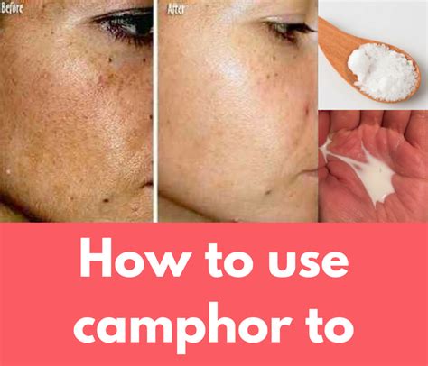How To Remove Pimple Holes From Face Home Remedies Howtormeov
