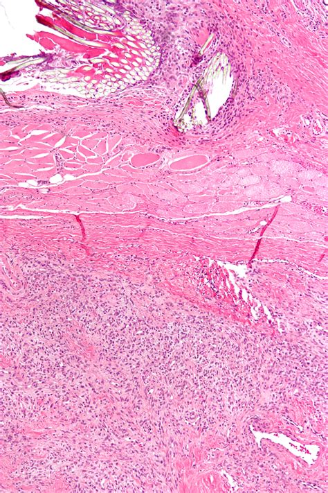 Neoplasms Fibrous Tissue