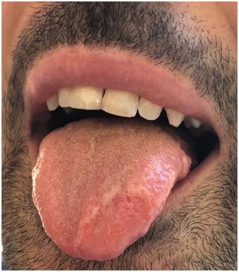 Gonorrhea Lips Symptoms Lipstutorial Org