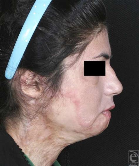 Preoperative Lateral View Deformity Of Lower Lip Chin Retrusion And