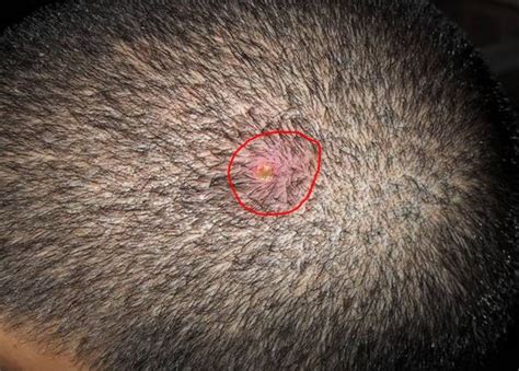 Pimples On Scalp Causes Small Painful Itchy Get Rid