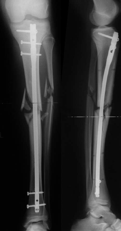 Initial Situation Of A Tibial Fracture In A 22 Year Old Man In Two