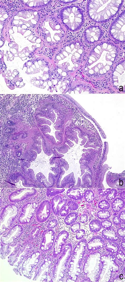 Histopathologic Features Of Serrated Lesions A Goblet Cell Rich