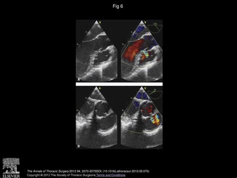 Perventricular Device Closure Of Doubly Committed Subarterial Ventral