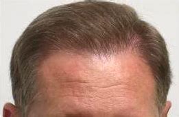 Fine Hair and Large Bald Area - Hair Transplant Web
