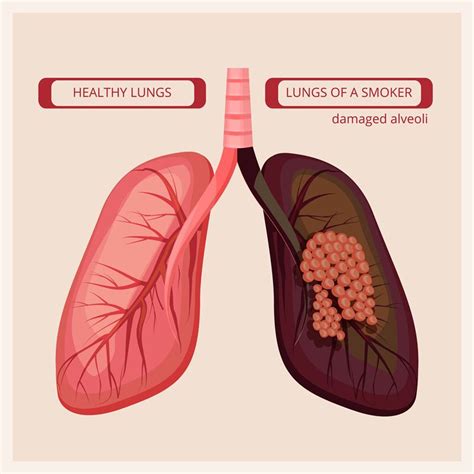 Smoker Lungs Smoke Human Damage Lung Cancer Vector Medical Infographi