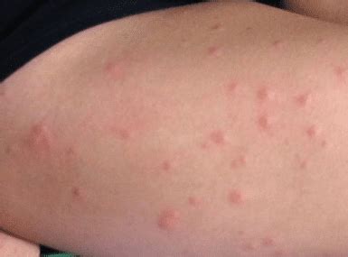 You must be thinking that how long would it take to learn piano for me? Sand Fly Bites Treatment, Pictures, Symptoms, Healing Time ...