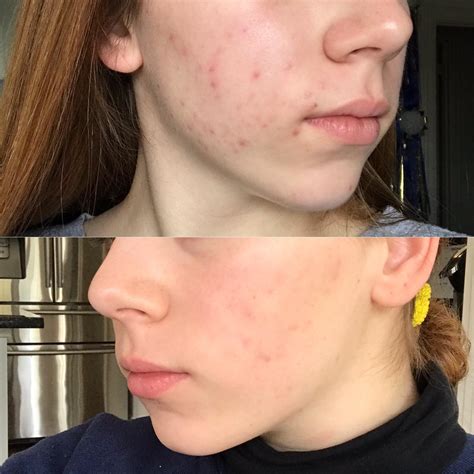 Months In Started With Moderate But Stubborn Cystic Acne R Accutane