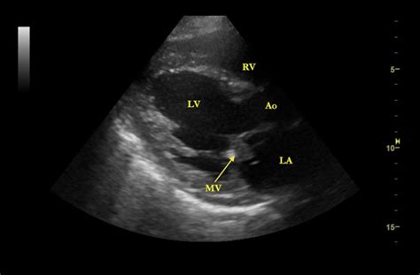 Cardiac Point Of Care Ultrasound For The Diagnosis Of Infective