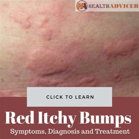 Red Itchy Bumps On Skin Causes Treatment Pictures Minhhai2d Help