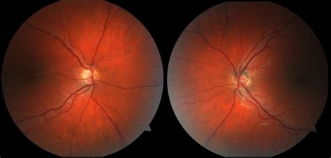 Incidental Bilateral Optic Nerve Hypoplasia Bmj Case Reports