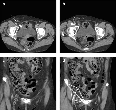 Femoral Hernia Containing Appendicitis A B Axial Ct Images