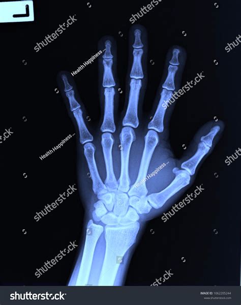 Film Xray Hand Ap Show Normal Foto De Stock 1062205244 Shutterstock