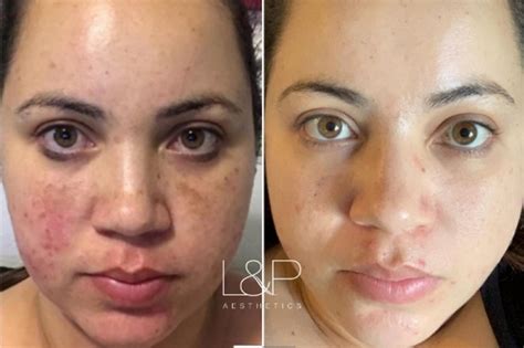 Bbl Skin Treatment Before And After Your Magazine Lite