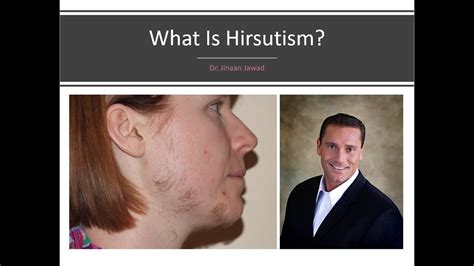 What Is Hirsutism Facial Hair Youtube