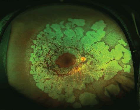 Optomap Retinal Imaging Discovery Optometry