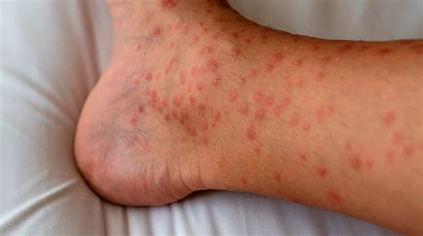 Prosper Allergic Cash Treatment Of Eczema On Body Resignation Blast