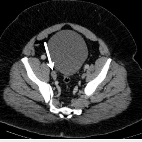 Axial Ct Scan Of The Pelvic Region A Mildly Enlarged 126 Mm