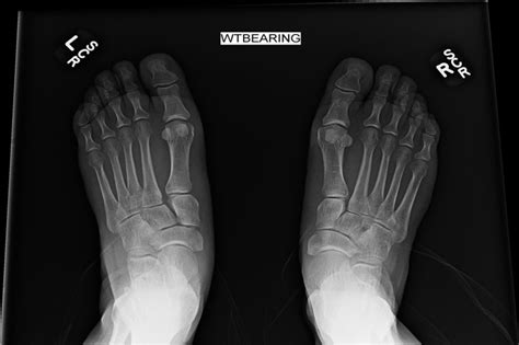 Ortho Dx Foot Pain And Swelling Following Accident Clinical Advisor