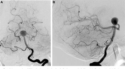 Figure From A Double Barrel Superficial Temporal Artery To Superior