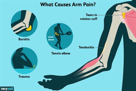 Arm Pain Common Causes And Emergency Signs