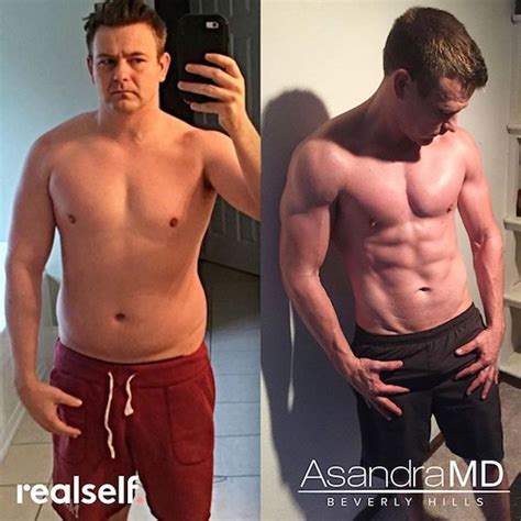 Patient 289 Testosterone Replacement Therapy Before And After Photos Beverly Hills Plastic