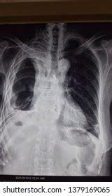 Pleural eﬀusions can loculate as a result of adhesions. Loculated Pleural Effusion Images, Stock Photos & Vectors ...