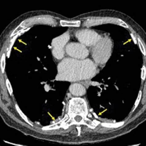 4 Pleural Plaques Ct Chest Axial View Showing Multiple Bilateral