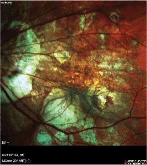 Multimodal Image Shows The Presence Of Chorioretinal Scars In Myopic