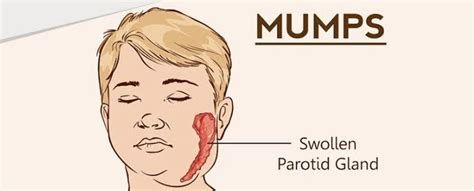 South Africa Alert Mumps On The Rise Central News South Africa