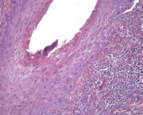 Scielo Brasil Sycosiform Tinea Barbae Caused By Trichophyton Rubrum