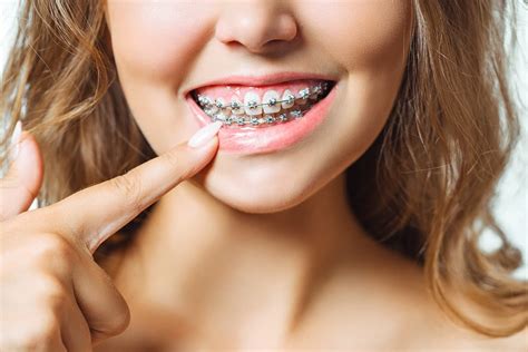 Reasons To Get Adult Braces Texas Orthodontists