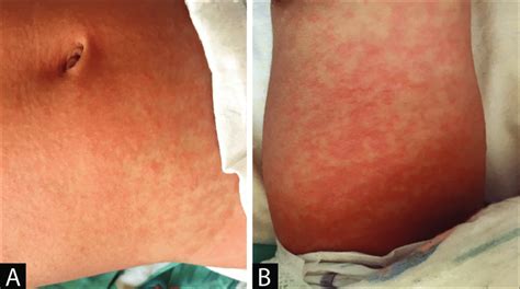 Maculopapular Rashes In The Abdomen Region A And Leg B Of The Case