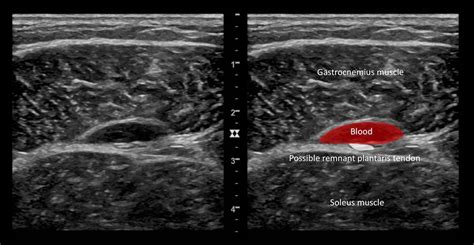 Gastrocnemius Vein Anatomy Ultrasound Venous Incompetence Ultrasound