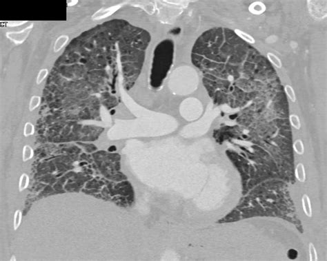 Pulmonary Edema In Patient With Interstitial Lung Disease Chest Case