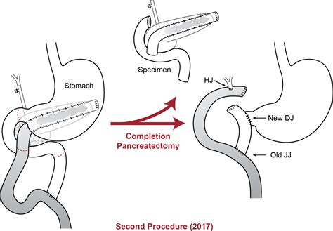 Completion Pancreaticoduodenectomy For Hereditary Pancreatitis After