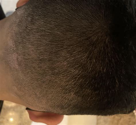 Bumps On Back Of Head After Haircut Rmedical