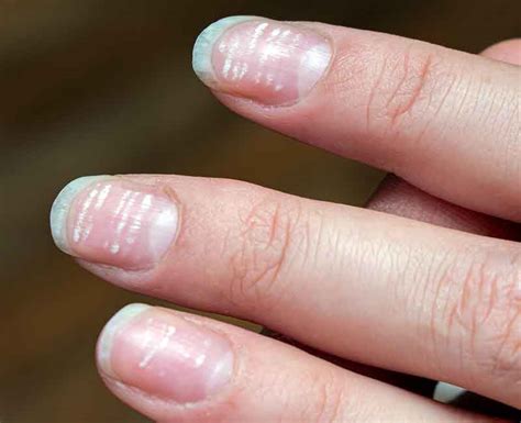 White Spots On Nails Leukonychia Causes And Treatment