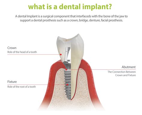 Dental Tooth Implant Malaysia Tanam Gigi Dental Clinics Dentists Klinik Gigi In