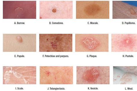 M Word To Describe Skin Lesion Borders