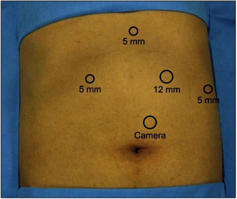 Trocar Placement For Laparoscopic Fundoplication Two Mm Trocars And Download Scientific