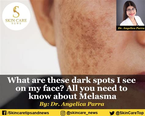 What Are Dark Spots All You Need To Know About Melasma