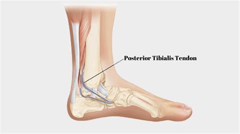 Posterior Tibial Tendonitis Diagnosis Symptoms And Treatments