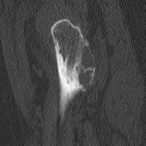 Pathological Lesser Trochanter Fracture Image